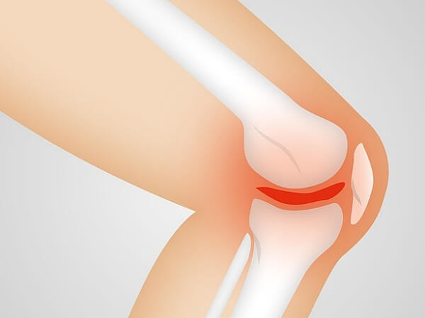 무릎통증-관절