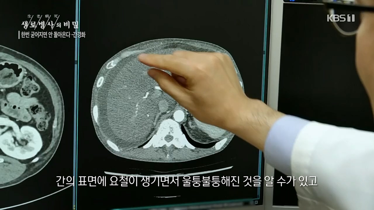 생로병사의 비밀.E863.230406p.H264-F1RST.mp4_20230406_202714.408.jpg