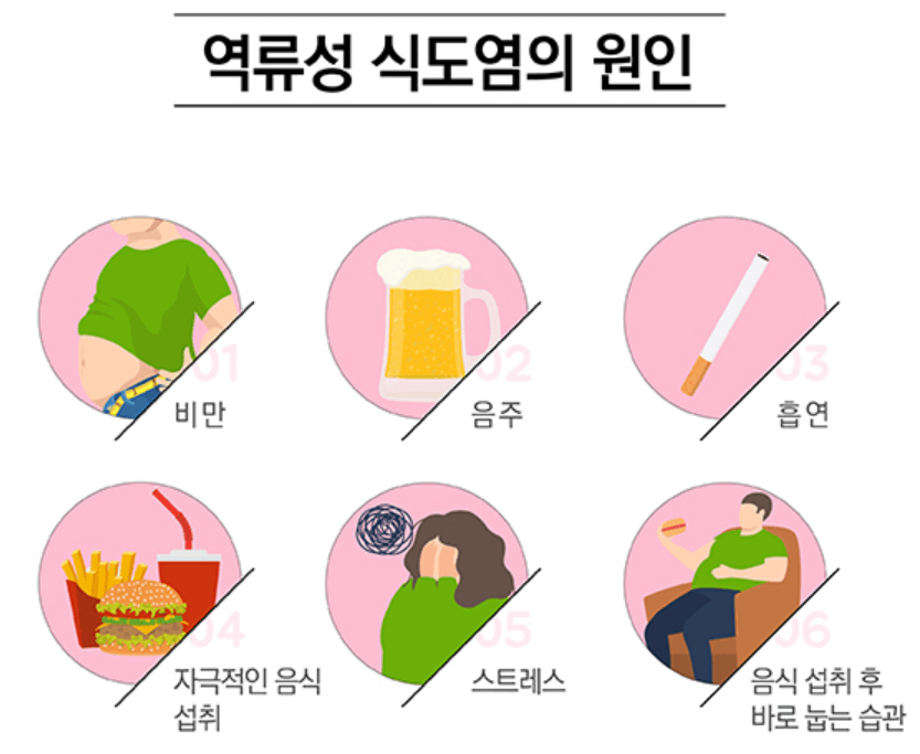 역류성 식도염 원인과 치료법