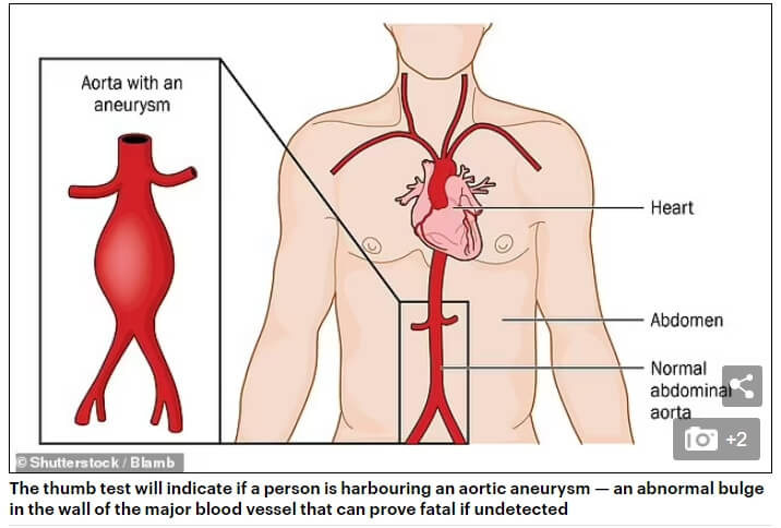  소리 없이 찾아오는 병 대동맥류 간단한 테스트법 VIDEO:Simple thumb test can indicate if you're harbouring an aortic aneurysm - an abnormal bulge....