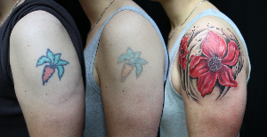 tatoo
tatoos
tatoo remove
remove