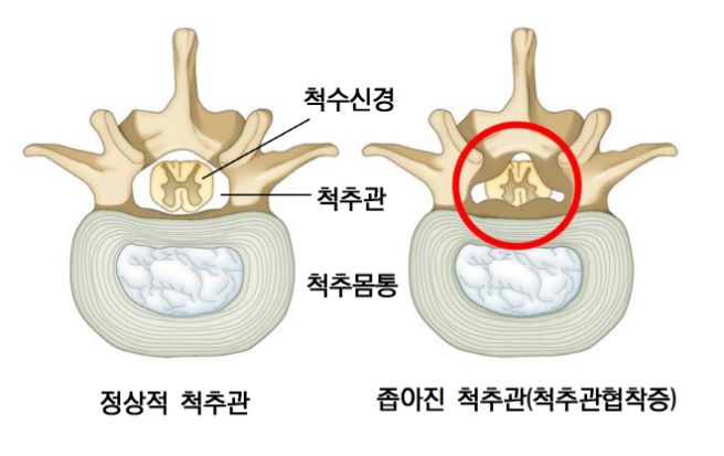 척추관 협착증 증상