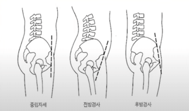 골반-전방경사와-후방경사-그리고-중립된-자세-그림