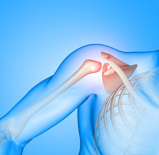 shoulder-impingement-syndrome