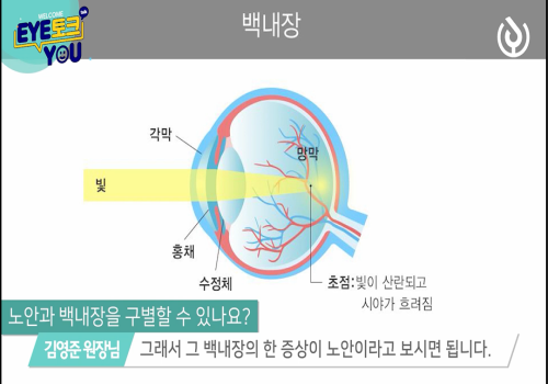 백내장 증상