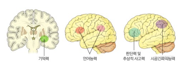  루이체 치매 증상