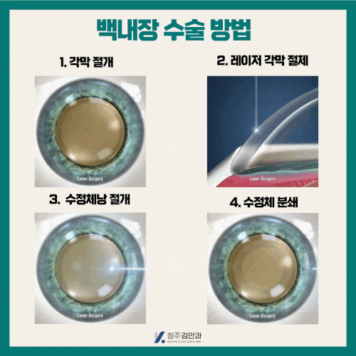  백내장실비보험 정밀 검진과 진단 중요!