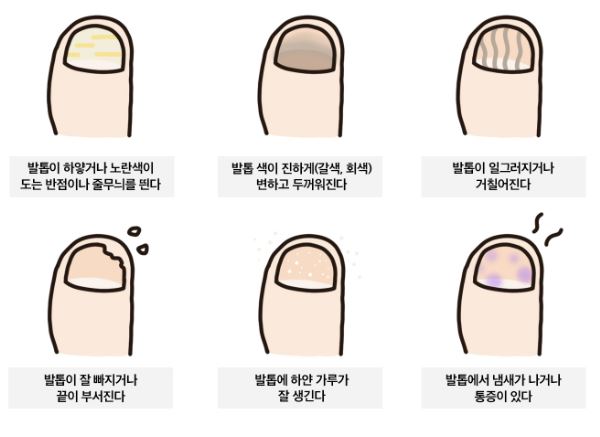 발톱 무좀 자가 진단법