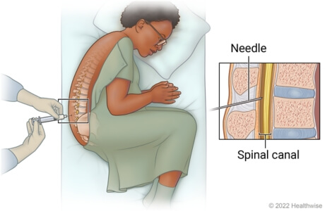 spinal tapping