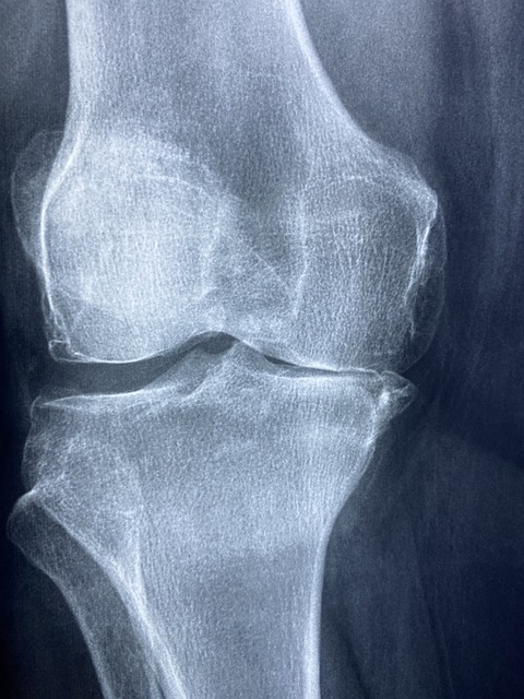 이것은 무릎 엑스레이를 촬영한 사진입니다.