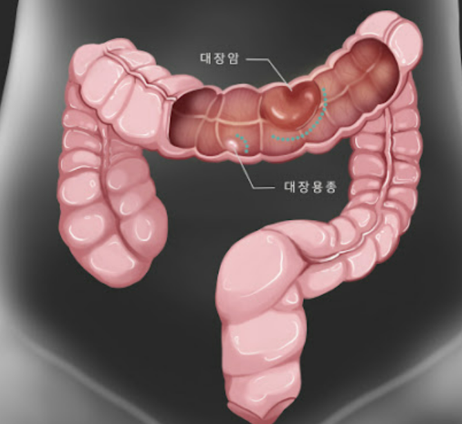 대장암 초기증상 10가지