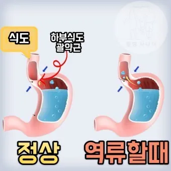 식도염에 좋은 음식 안좋은 음식_8