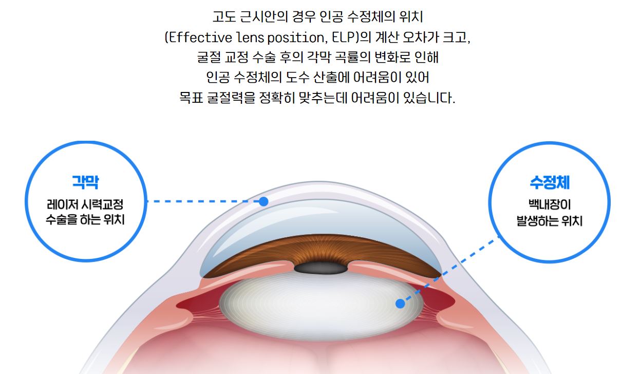 수정체와 각막의 위치