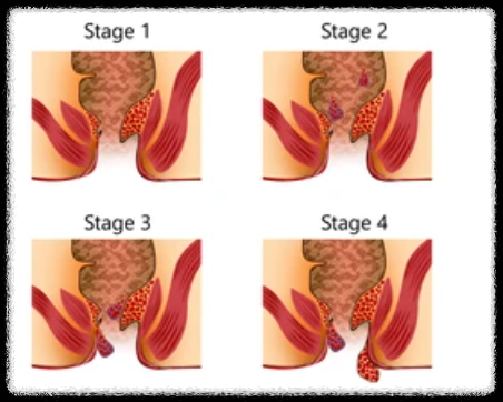 치질의 4단계