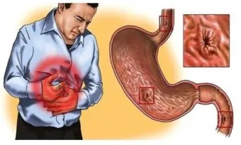 속쓰림 원인 증상 치료하는 방법_18