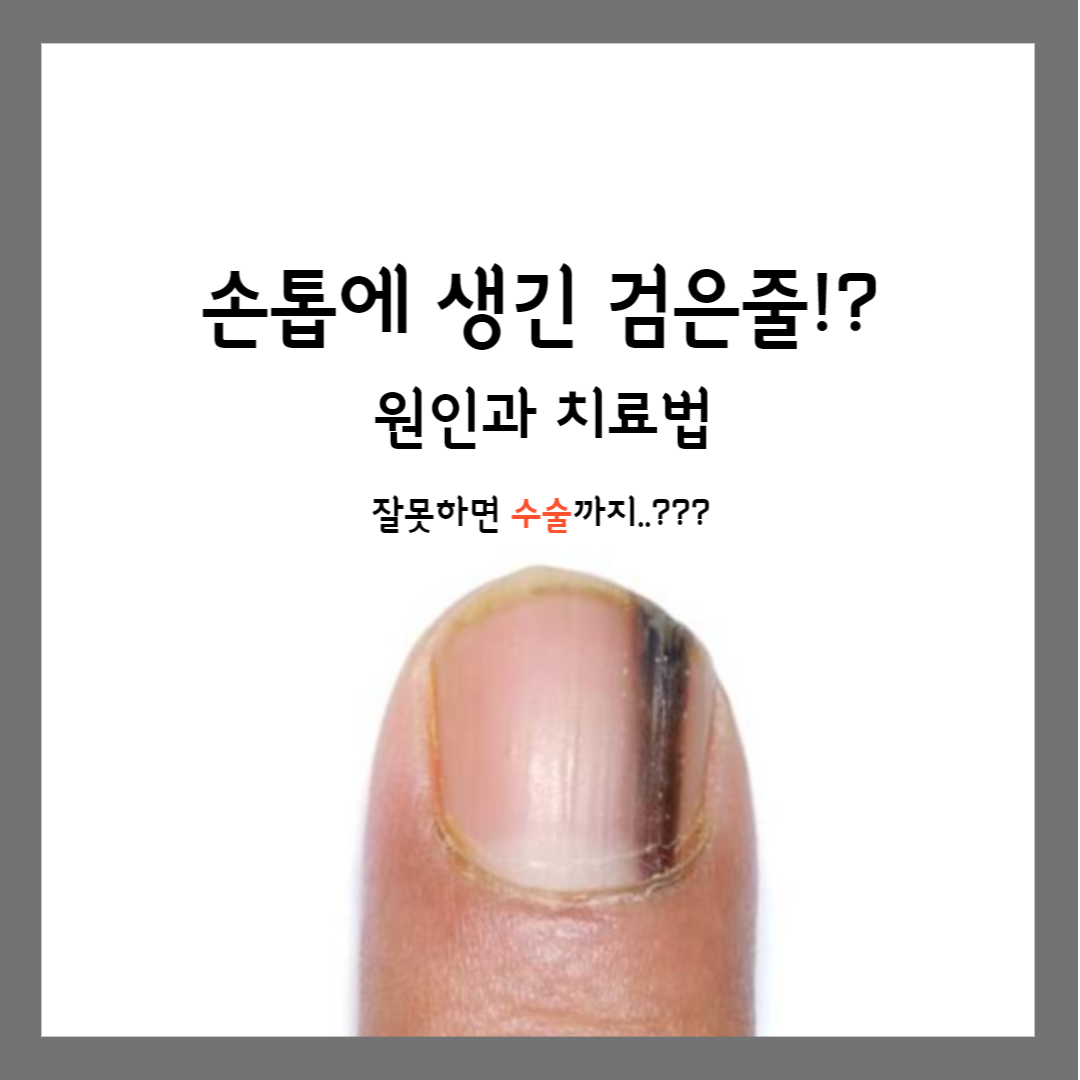  손톱에 검은 줄이 생겼다면!? 심각하면 수술까지도..?