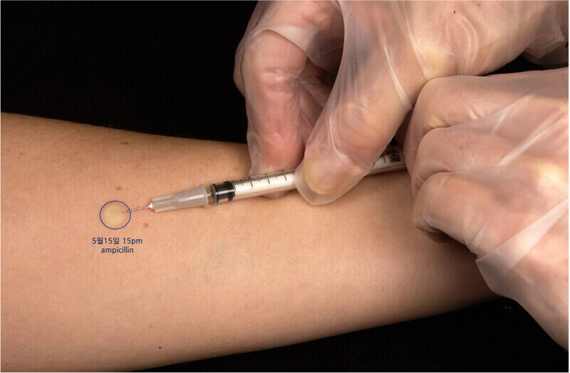 의학용어 ID injection 뜻 피내주사 부위, 피내주사 핵심술기