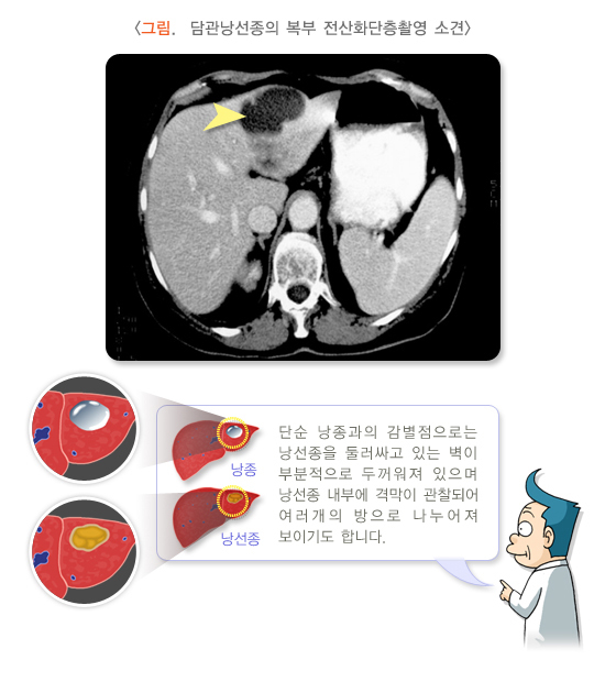  간의 양성종양