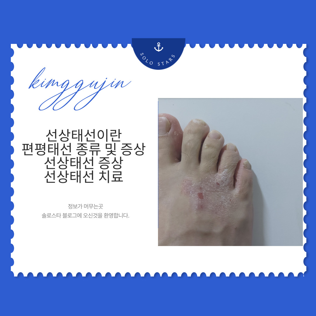 선상태선 관련 사진