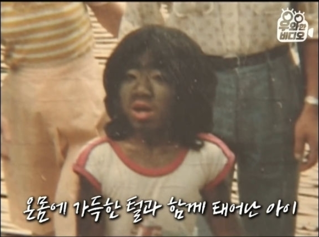  세계에서 털이 가장 많은 사람으로 기네스북에 기록된 사나이
