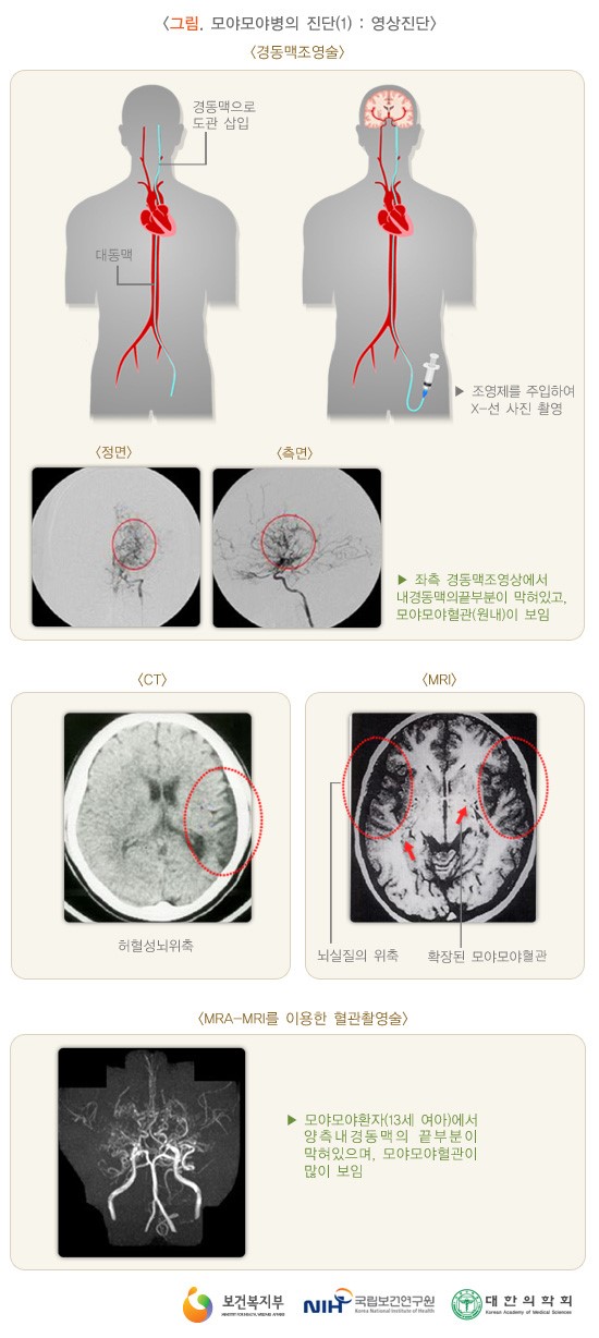  슬기로운 의사생활의 모야모야병! 궁금하다! 무슨 병일까?!