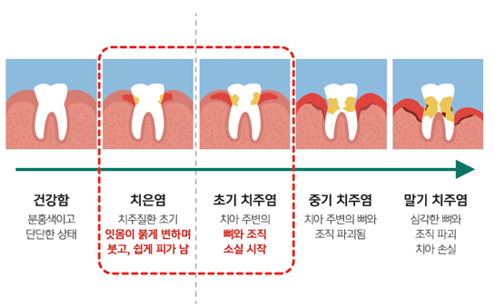 치은염과 치주염의 진행 정도 (출처 : 그린스토어)