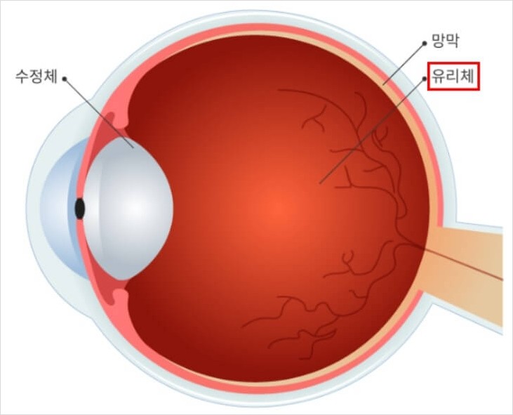  눈앞에 날파리 비문증, 인공눈물 효과