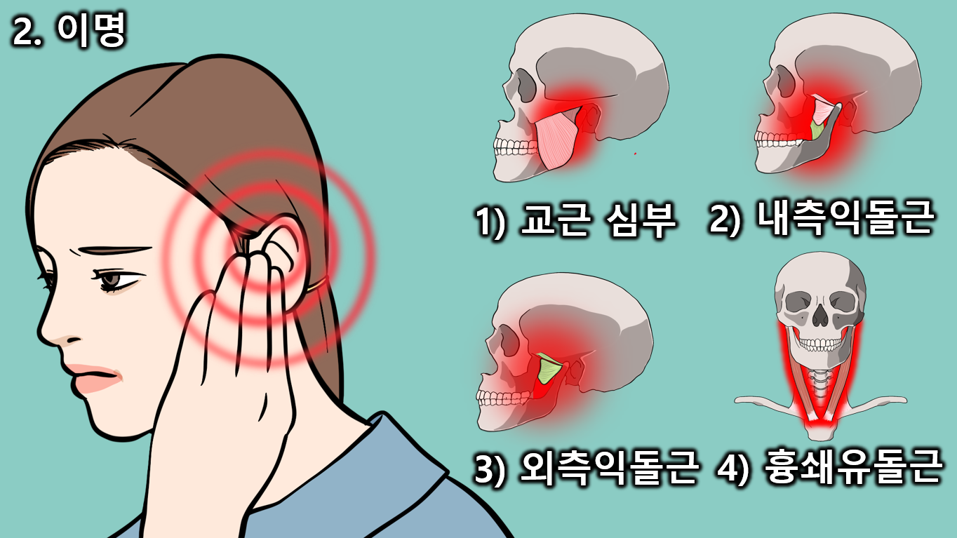 턱관절 근육통 통증유발점과 이비인후과 증상 총정리