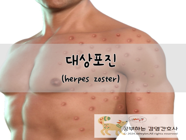 대상포진(herpes zoster): 원인, 증상, 치료 및 예방