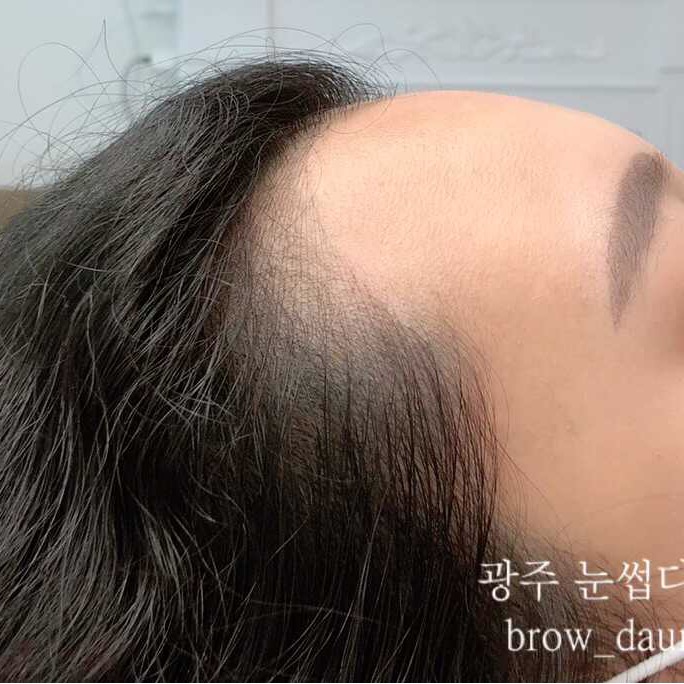  광주 헤어라인문신 "눈썹다움" 후기 탈모가 걱정이라면?