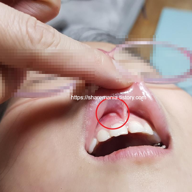  구내염은 어린이집 보내면 안되는 전염병입니다. 빨리 치료해줘야해요.