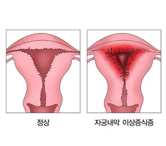 자궁내막 이상증식증 출처 서울 아산 병원 홈페이지