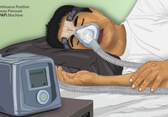 수면무호흡증의 증상과 진단