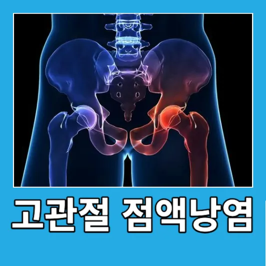 고관절 점액낭염 좌골 복숭아뼈 점액낭염 원인 증상 치료