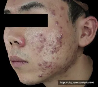 흉터전용 치료 추천 스카덤 겔 효능효과_5
