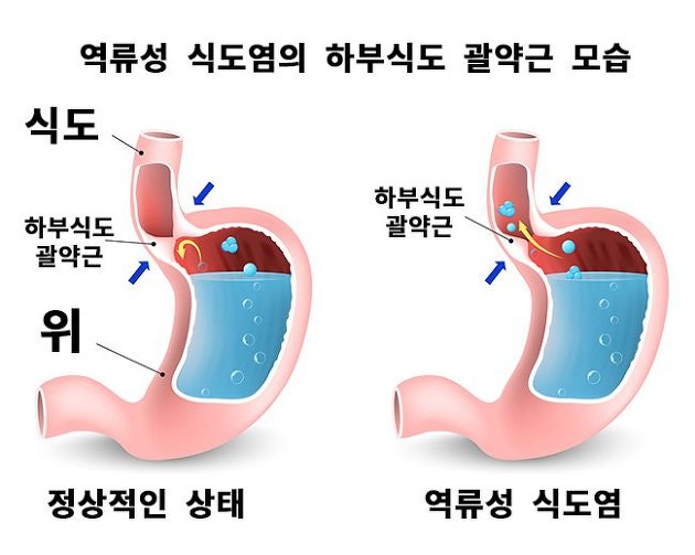 역류성 식도염 증상 원인 자연치료 방법 정보 총정리3