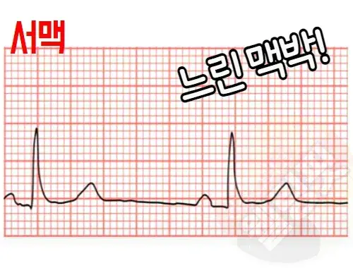 맥박이-느린-서맥-그래프