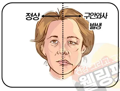 구안와사는-얼굴-반쪽에-발생하는-안면-마비-질환입니다.