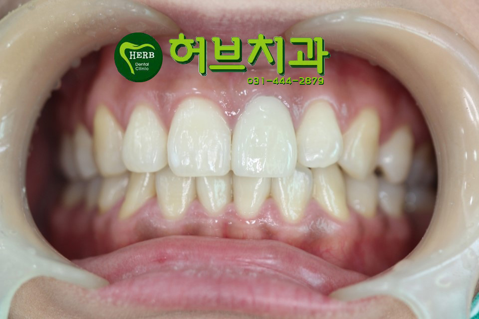 금이 케이스 이미지