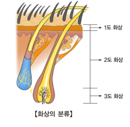  화상 치료방법/유형/합병증