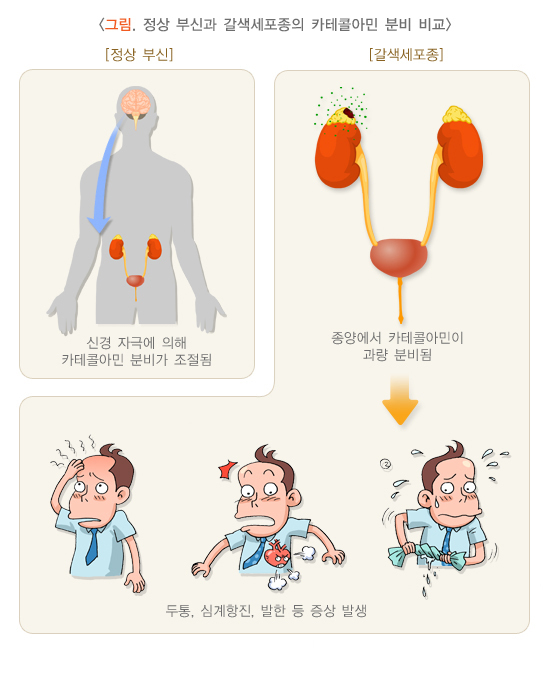  갈색세포종