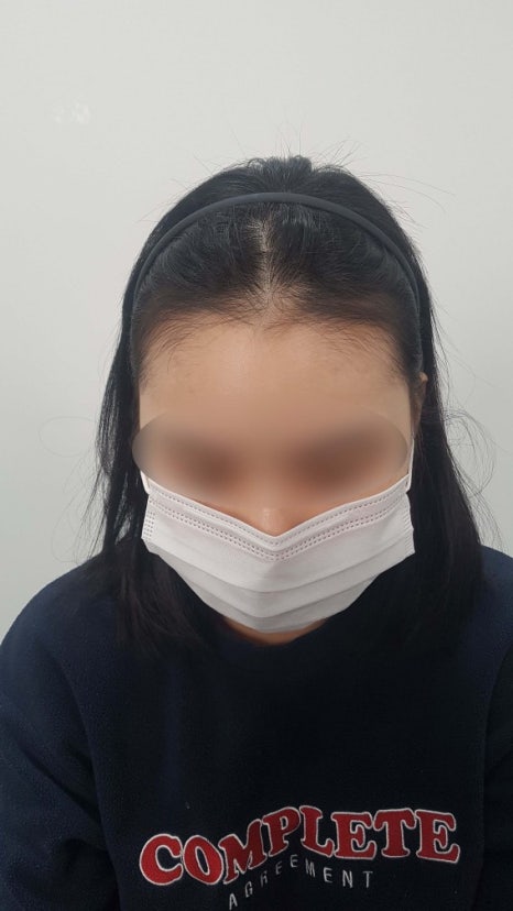 여자 헤어라인 두피문신 전