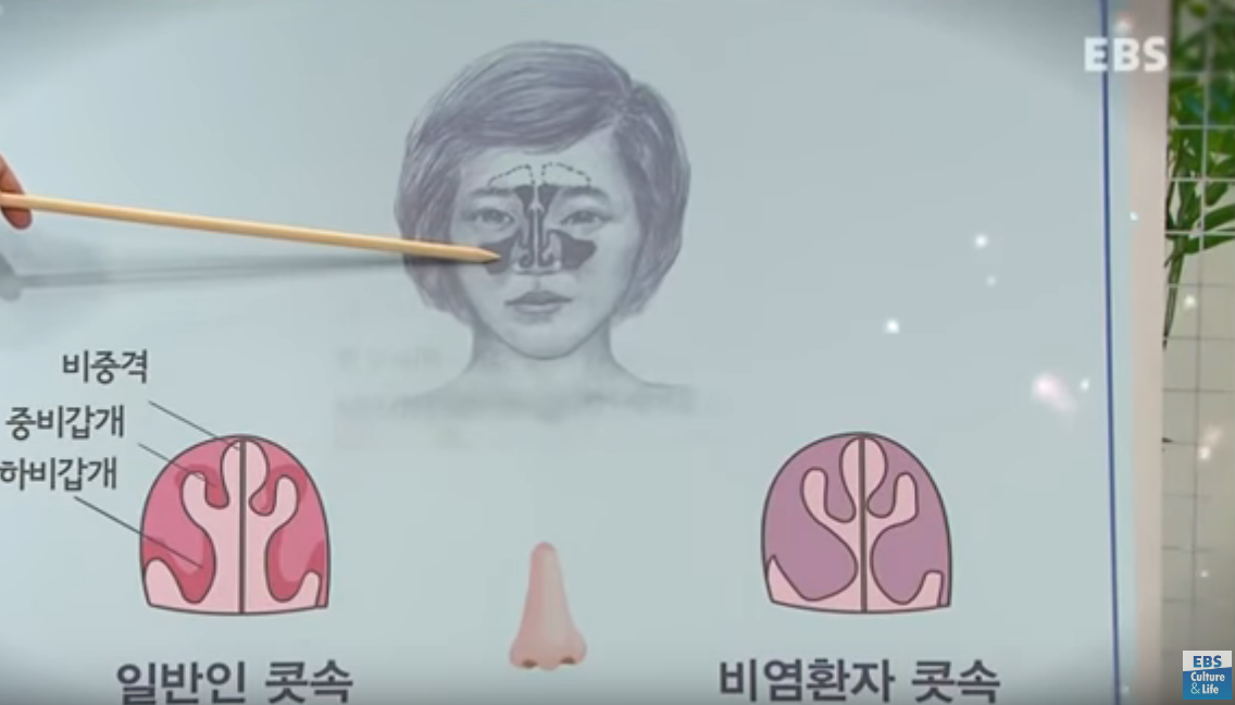 알레르기 비염, 만성비염의 차이점