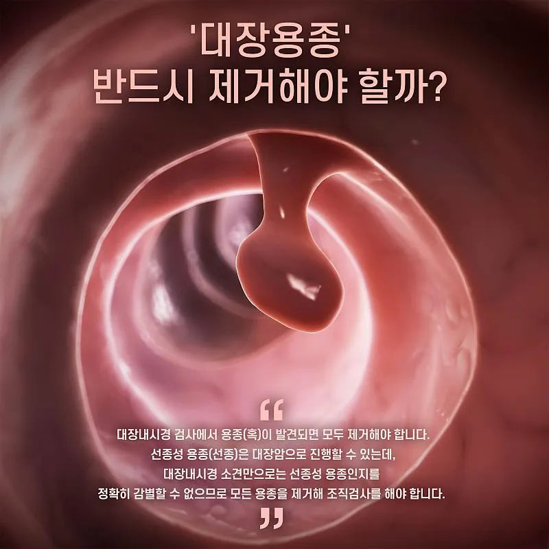 대장내시경 용종제거 후 식사 식단조절_5