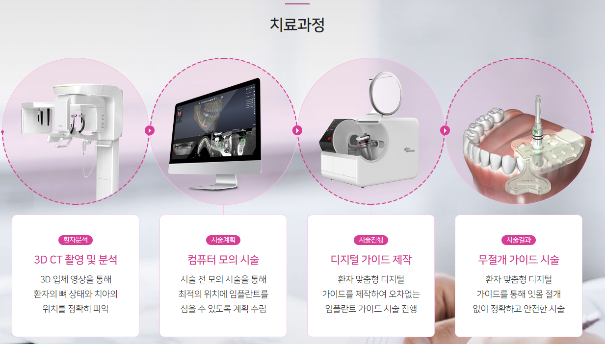 임플란트가격