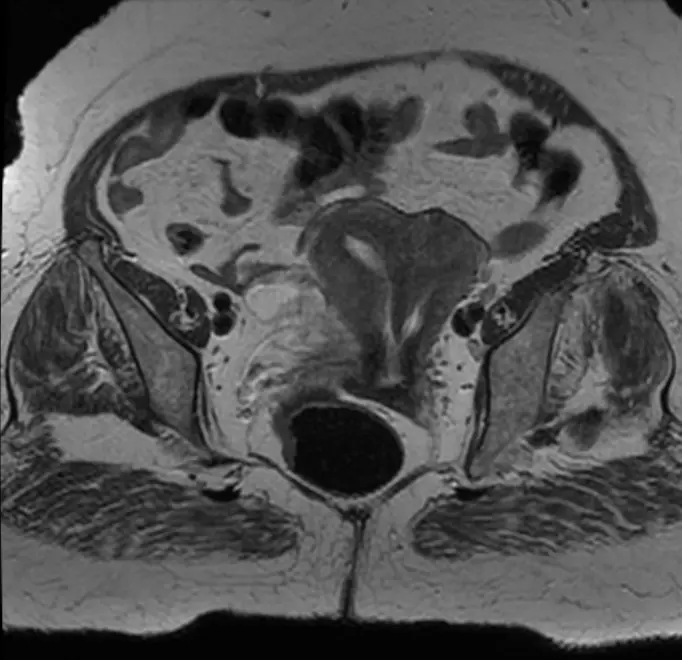 중격자궁의 MRI 소견