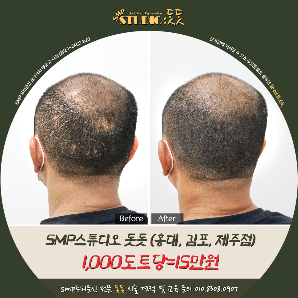  머리 흉터, 수술 흉터, 땜빵 커버는 두피문신으로 간단하게 해결