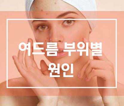  여드름 부위별 원인으로 건강상태 체크하기