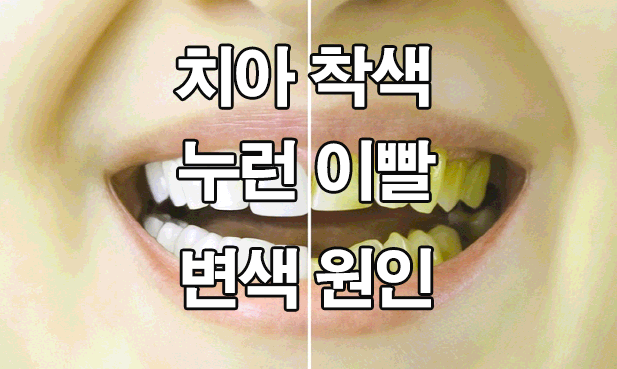  치아 착색, 누런 이빨 : 변색 원인