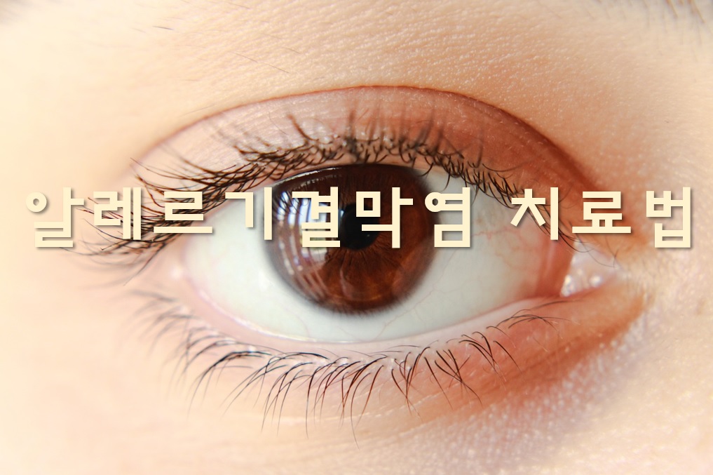  알레르기 결막염 치료법과 안약 효과